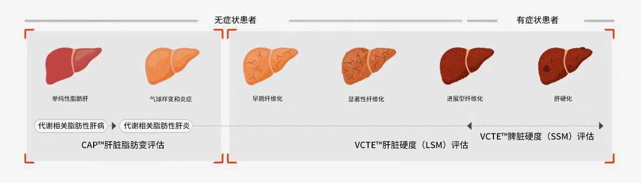 Le test FibroScan® peut fournir une base pour les décisions de traitement des diverses maladies du foie